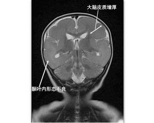 广州借卵助孕机构【刚怀孕流产孩子怎么办】